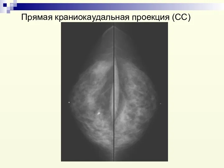 Прямая краниокаудальная проекция (СС)