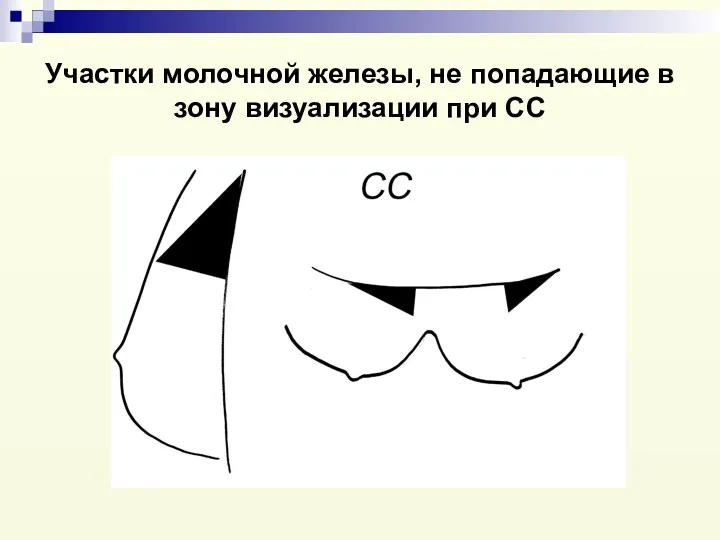 Участки молочной железы, не попадающие в зону визуализации при СС