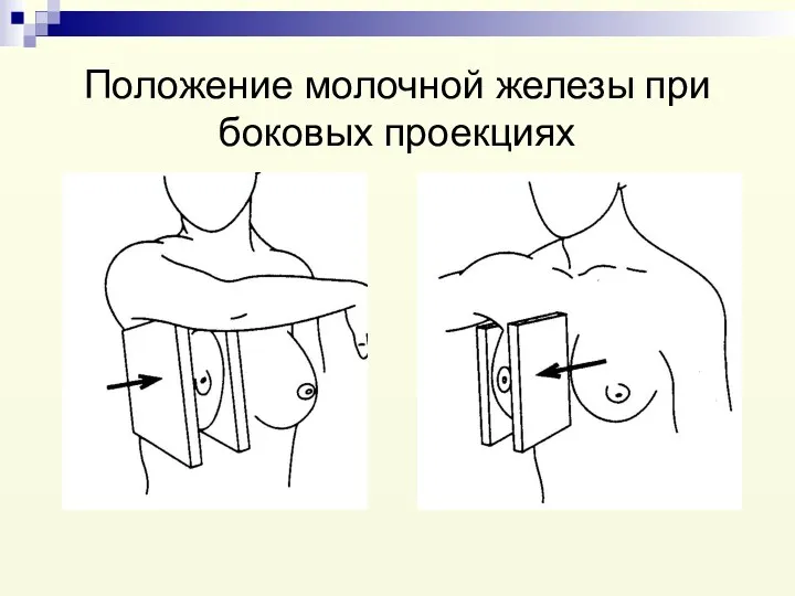 Положение молочной железы при боковых проекциях