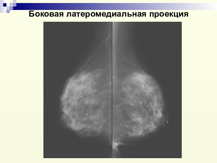 Боковая латеромедиальная проекция