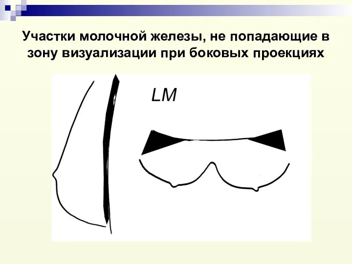 Участки молочной железы, не попадающие в зону визуализации при боковых проекциях