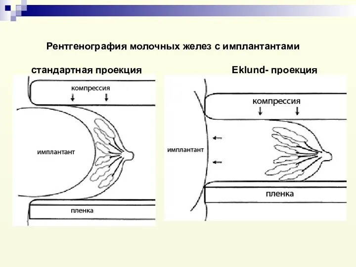 Рентгенография молочных желез с имплантантами стандартная проекция Eklund- проекция