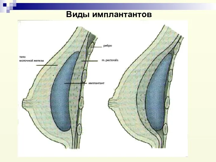 Виды имплантантов