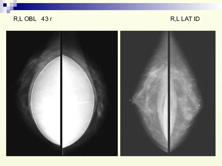 R,L OBL 43 г R,L LAT ID