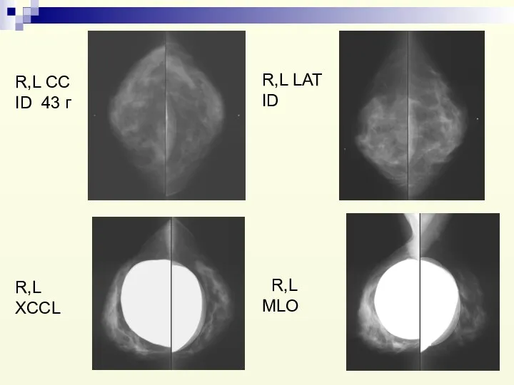 R,L CC ID 43 г R,L XCCL R,L LAT ID R,L MLO