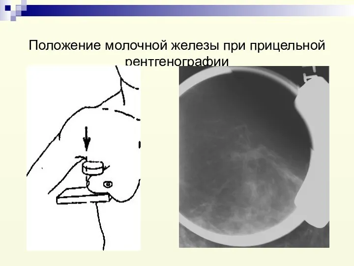 Положение молочной железы при прицельной рентгенографии