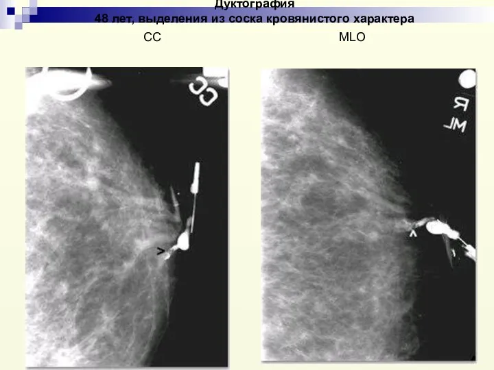 Дуктография 48 лет, выделения из соска кровянистого характера СС MLO