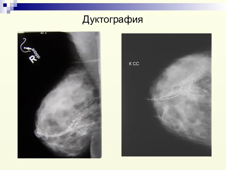 Дуктография К СС 40 л