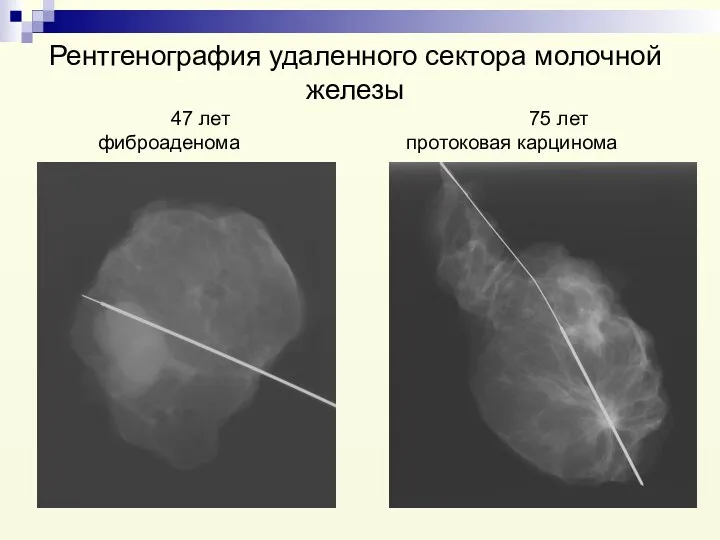 Рентгенография удаленного сектора молочной железы 47 лет 75 лет фиброаденома протоковая карцинома