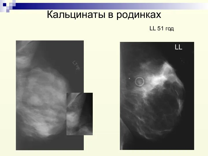 Кальцинаты в родинках LL 51 год LL