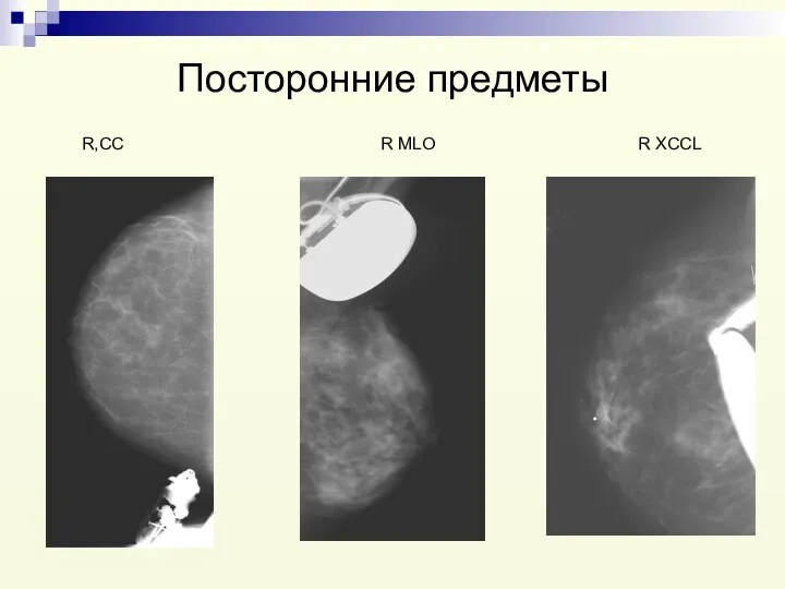 Посторонние предметы R,CC R MLO R XCCL