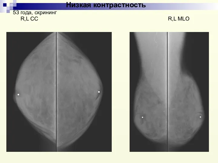 Низкая контрастность 53 года, скрининг R,L CС R,L MLO