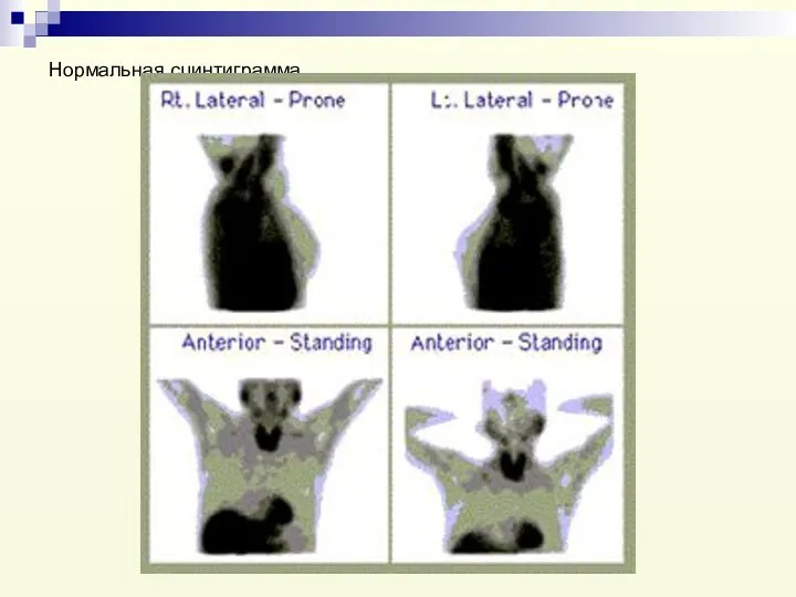 Нормальная сцинтиграмма