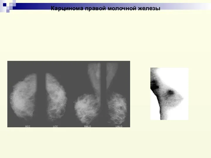 Карцинома правой молочной железы