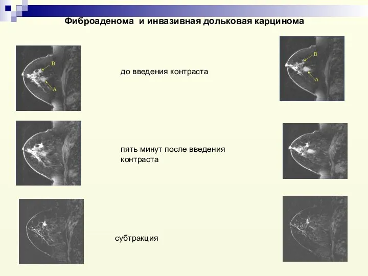 Фиброаденома и инвазивная дольковая карцинома субтракция пять минут после введения контраста до введения контраста