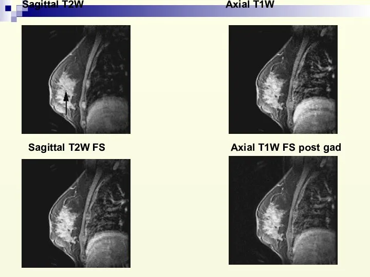 Sagittal T2W Axial T1W Sagittal T2W FS Axial T1W FS post gad