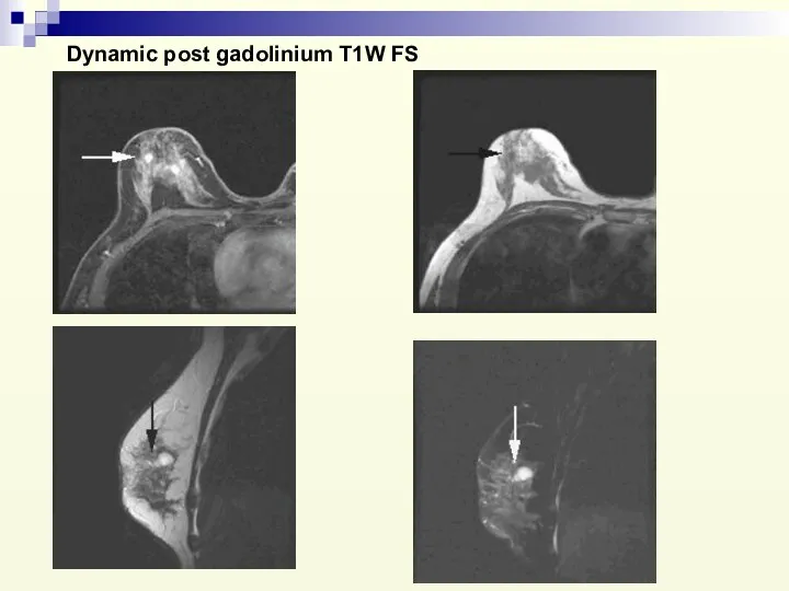 Dynamic post gadolinium T1W FS