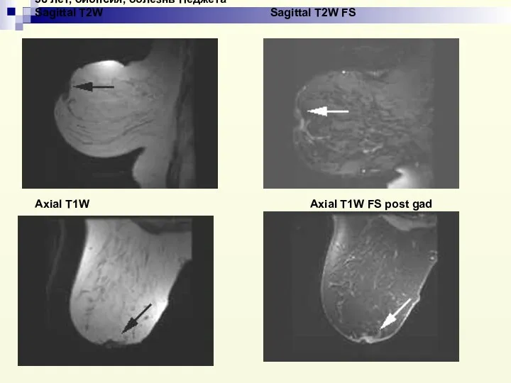 58 лет, биопсия, болезнь Педжета Sagittal T2W Sagittal T2W FS