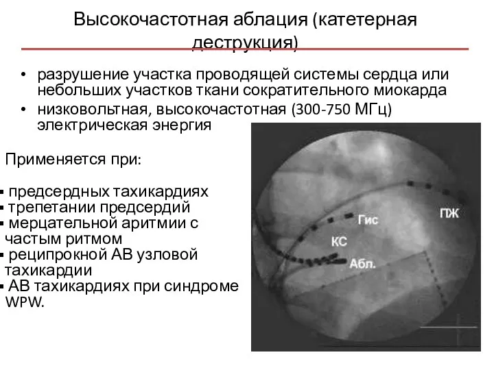 Высокочастотная аблация (катетерная деструкция) разрушение участка проводящей системы сердца или небольших участков ткани