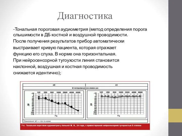 Диагностика -Тональная пороговая аудиометрия (метод определения порога слышимости в ДБ костной и воздушной