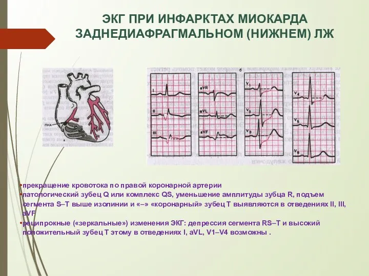 ЭКГ ПРИ ИНФАРКТАХ МИОКАРДА ЗАДНЕДИАФРАГМАЛЬНОМ (НИЖНЕМ) ЛЖ прекращение кровотока по