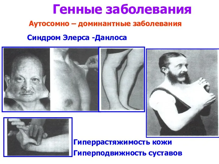 Генные заболевания Синдром Элерса -Данлоса Аутосомно – доминантные заболевания Гиперрастяжимость кожи Гиперподвижность суставов