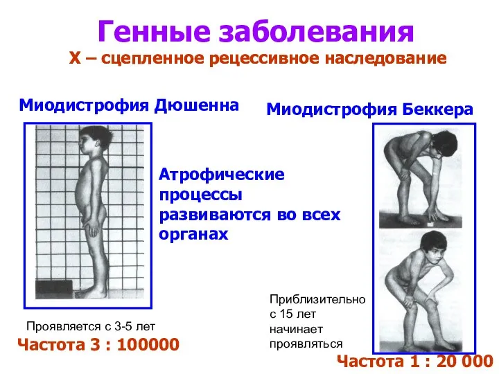 Генные заболевания Х – сцепленное рецессивное наследование Миодистрофия Дюшенна Частота