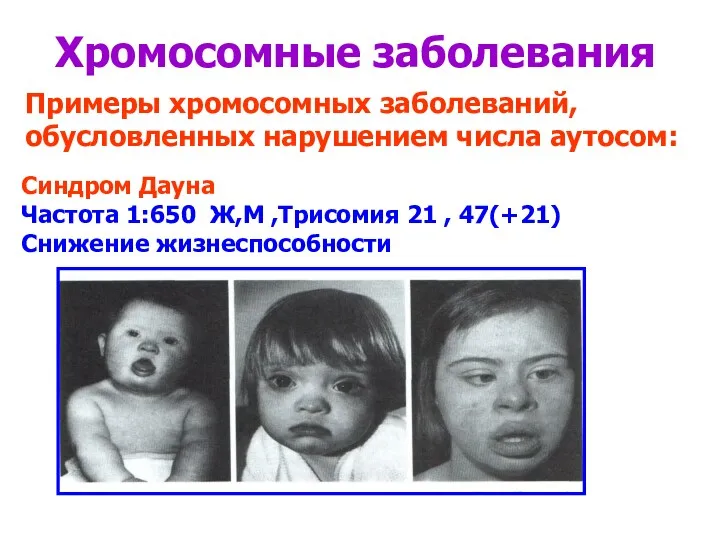 Хромосомные заболевания Примеры хромосомных заболеваний, обусловленных нарушением числа аутосом: Синдром Дауна Частота 1:650
