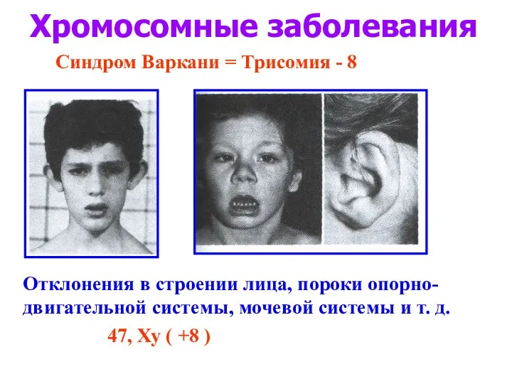 Хромосомные заболевания Синдром Варкани = Трисомия - 8 Отклонения в строении лица, пороки