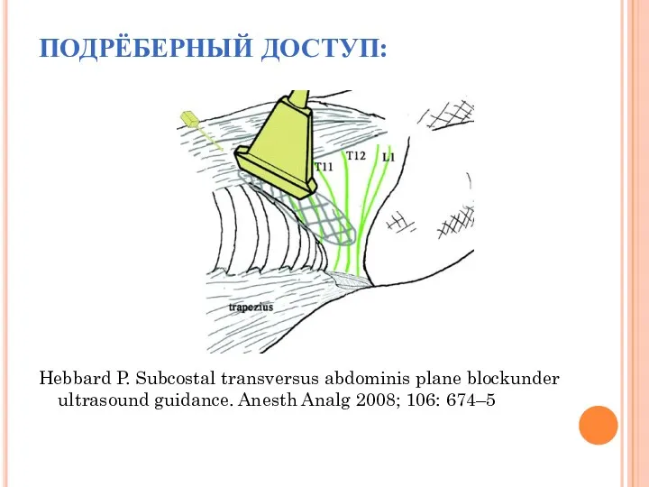 ПОДРЁБЕРНЫЙ ДОСТУП: Hebbard P. Subcostal transversus abdominis plane blockunder ultrasound guidance. Anesth Analg 2008; 106: 674–5