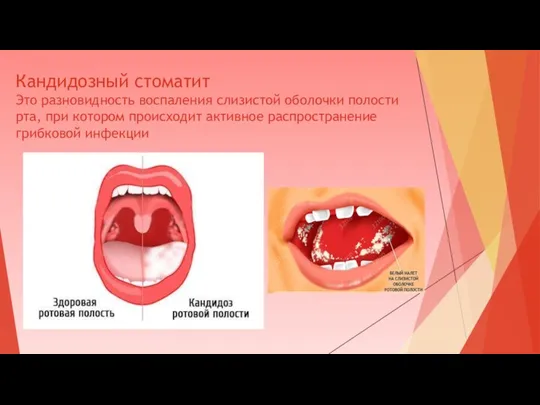 Кандидозный стоматит Это разновидность воспаления слизистой оболочки полости рта, при котором происходит активное распространение грибковой инфекции