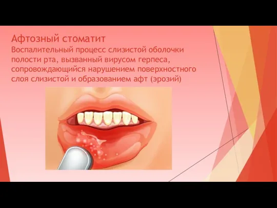 Афтозный стоматит Воспалительный процесс слизистой оболочки полости рта, вызванный вирусом герпеса, сопровождающийся нарушением