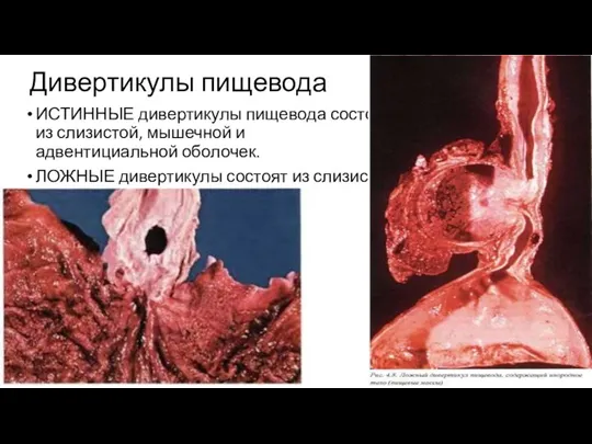 Дивертикулы пищевода ИСТИННЫЕ дивертикулы пищевода состоят из слизистой, мышечной и