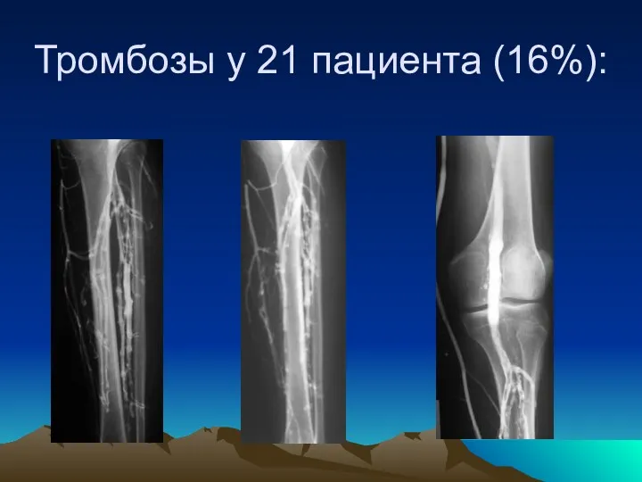 Тромбозы у 21 пациента (16%):