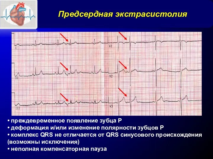 Предсердная экстрасистолия • преждевременное появление зубца Р • деформация и/или