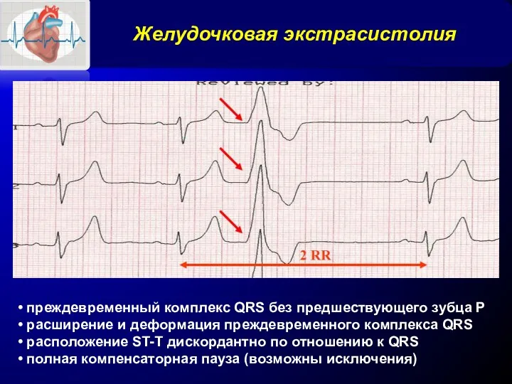 Желудочковая экстрасистолия • преждевременный комплекс QRS без предшествующего зубца Р