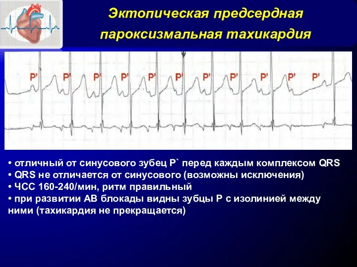 Эктопическая предсердная пароксизмальная тахикардия • отличный от синусового зубец Р`