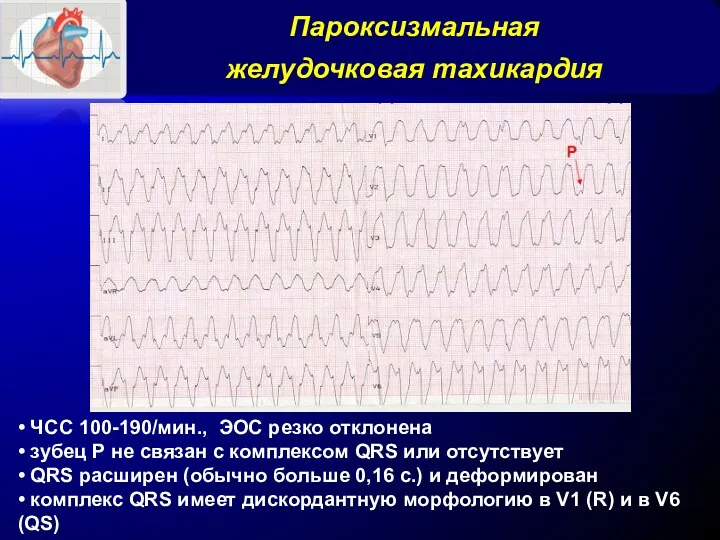 Пароксизмальная желудочковая тахикардия • ЧСС 100-190/мин., ЭОС резко отклонена •
