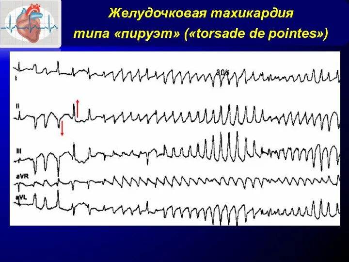 Желудочковая тахикардия типа «пируэт» («torsade de pointes»)