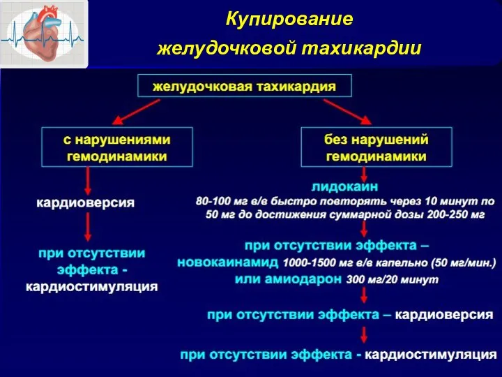 Купирование желудочковой тахикардии