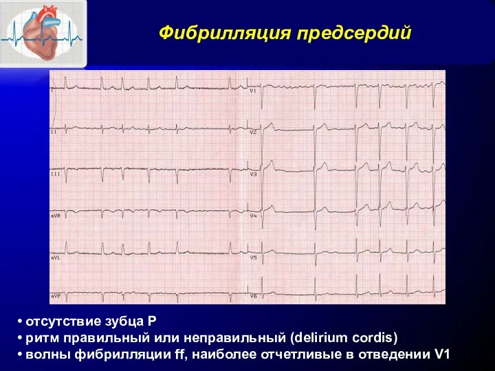 Фибрилляция предсердий • отсутствие зубца Р • ритм правильный или