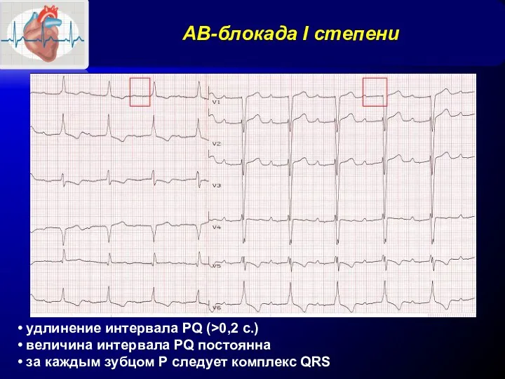 АВ-блокада I степени • удлинение интервала PQ (>0,2 с.) •