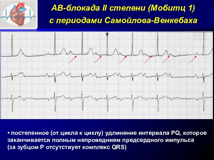 АВ-блокада II степени (Мобитц 1) с периодами Самойлова-Венкебаха • постепенное