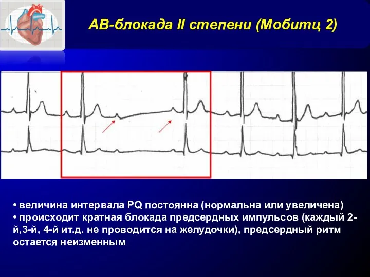 АВ-блокада II степени (Мобитц 2) • величина интервала PQ постоянна