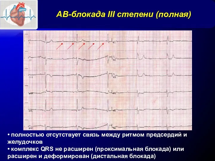 АВ-блокада III степени (полная) • полностью отсутствует связь между ритмом