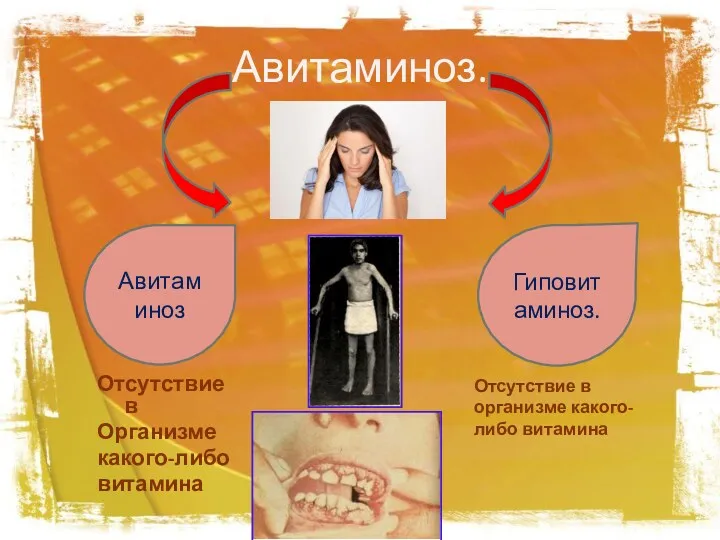 Авитаминоз. Отсутствие в Организме какого-либо витамина Авитаминоз Гиповитаминоз. Отсутствие в организме какого-либо витамина