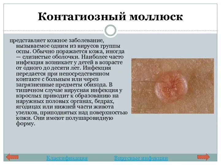 Контагиозный моллюск представляет кожное заболевание, вызываемое одним из вирусов группы оспы. Обычно поражается