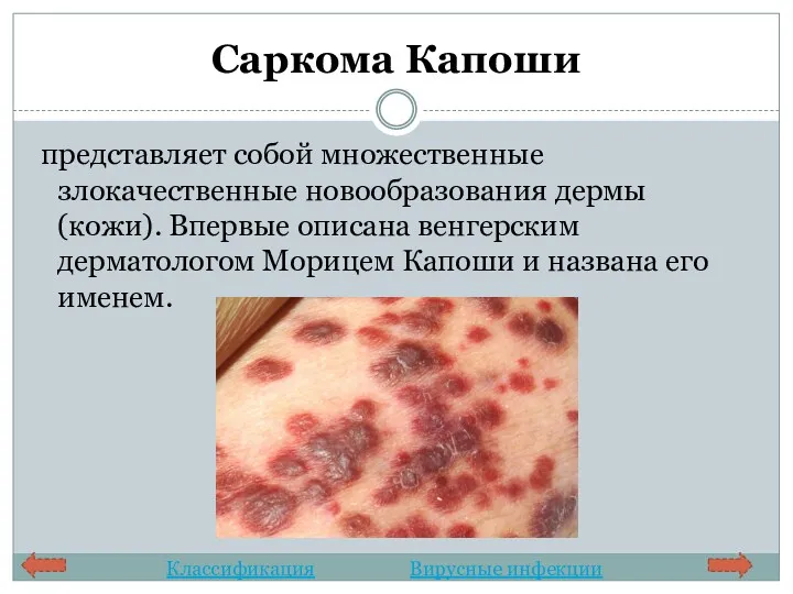 Саркома Капоши представляет собой множественные злокачественные новообразования дермы (кожи). Впервые описана венгерским дерматологом