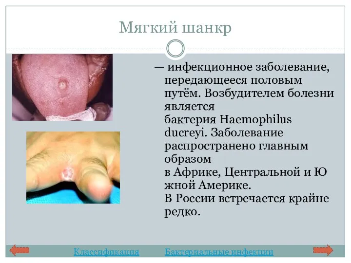 Мягкий шанкр — инфекционное заболевание, передающееся половым путём. Возбудителем болезни
