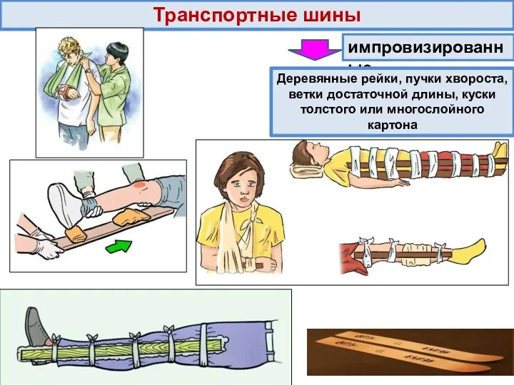 Транспортные шины импровизированные Деревянные рейки, пучки хвороста, ветки достаточной длины, куски толстого или многослойного картона